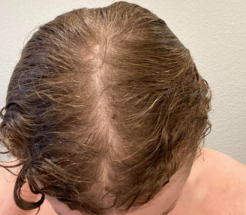 I Can See My Scalp Through My Hair – Am I Balding? (Male) 