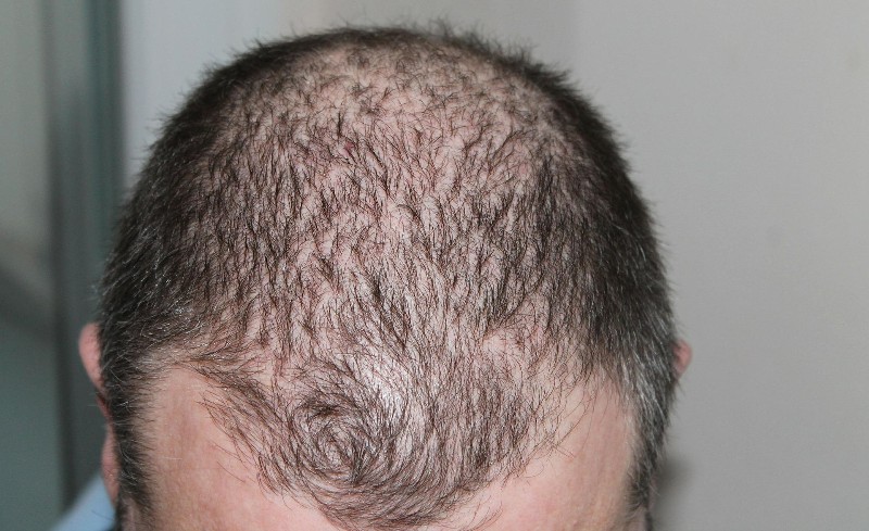 I Can See My Scalp Through My Hair – Am I Balding? (Male) 