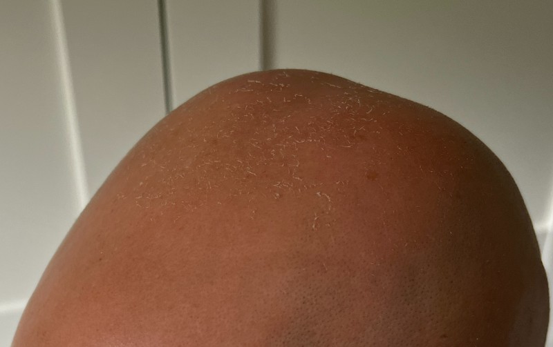 Sunburnt peeling bald head