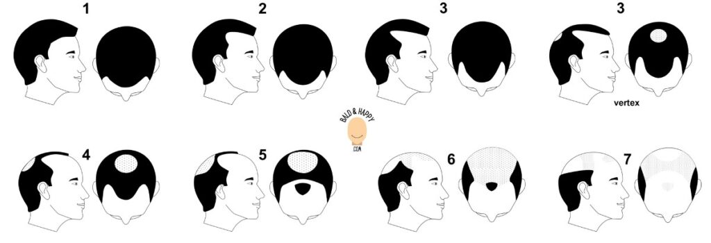 The Norwood-Hamilton Scale of Male Pattern Baldness