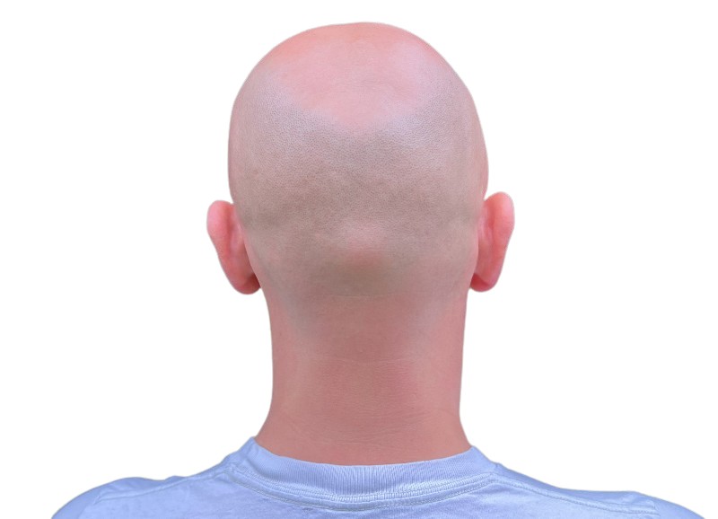 back of bald head