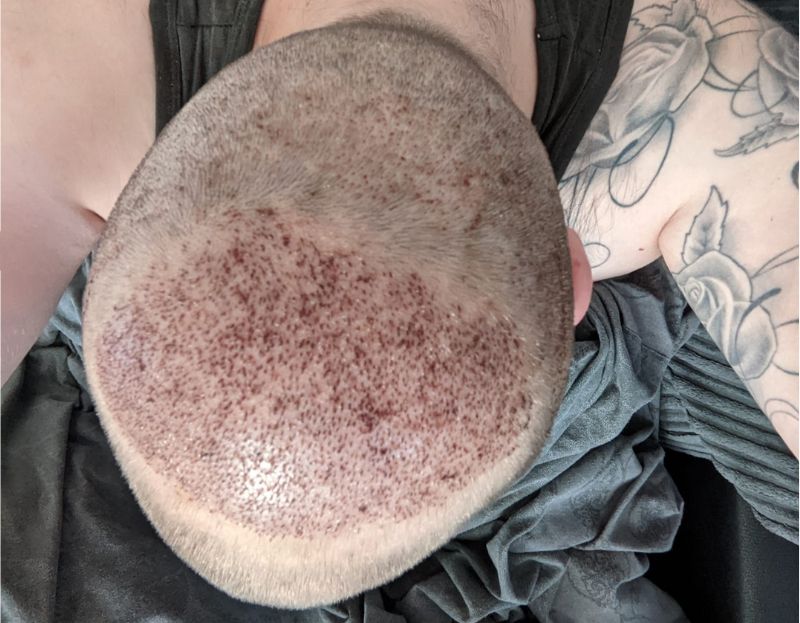 scarring after hair transplant
