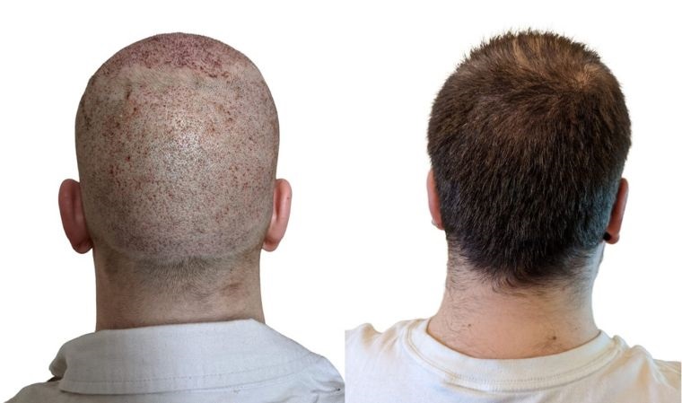 Hair transplant donor area growth after surgery
