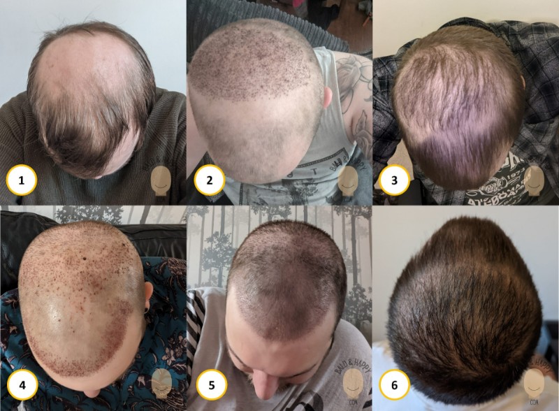 Does A Hair Transplant Hurt? (2023 Case Study)