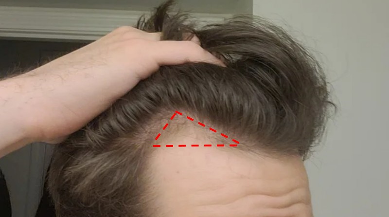 hairline with receding temples