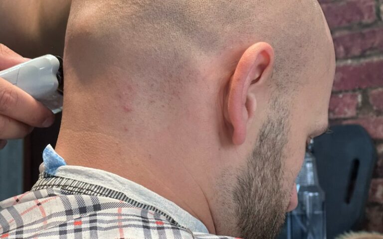 How To Prevent & Treat Razor Bumps On The Back Of Your Head