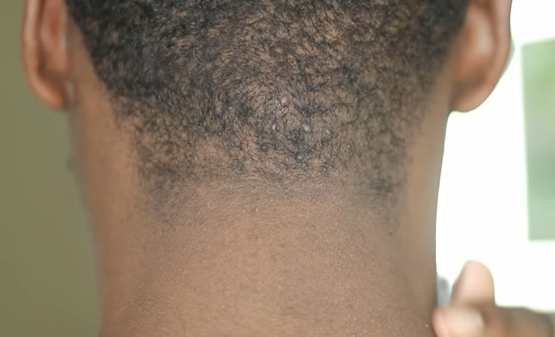 razor bumps on back of head