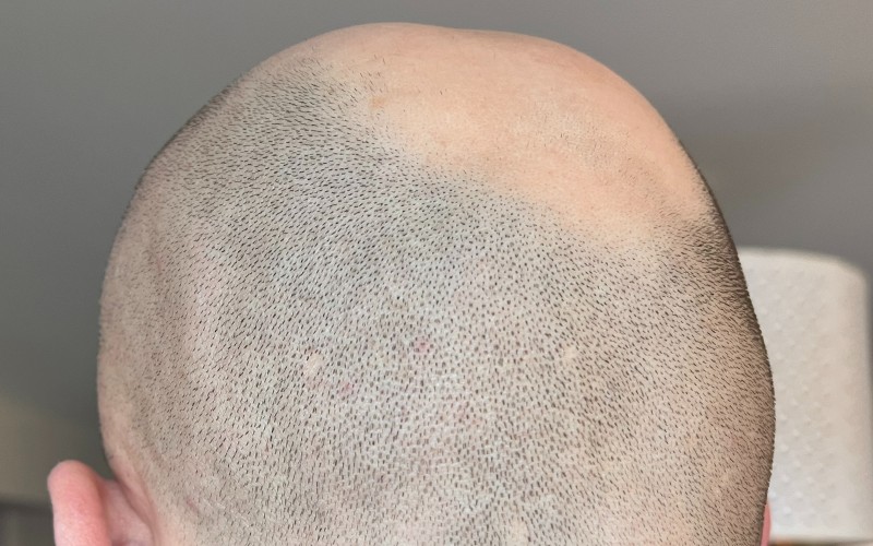 back of head horseshoe hair