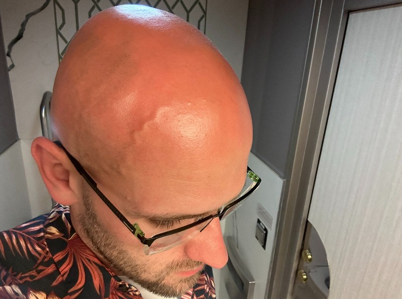 sunburn on a bald head