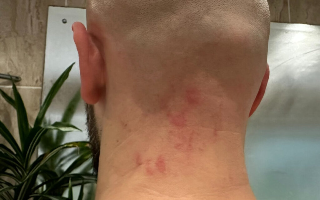 Irritation on back of neck from head shaving with electric shaver